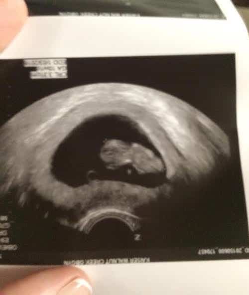 9 week Ultrasound