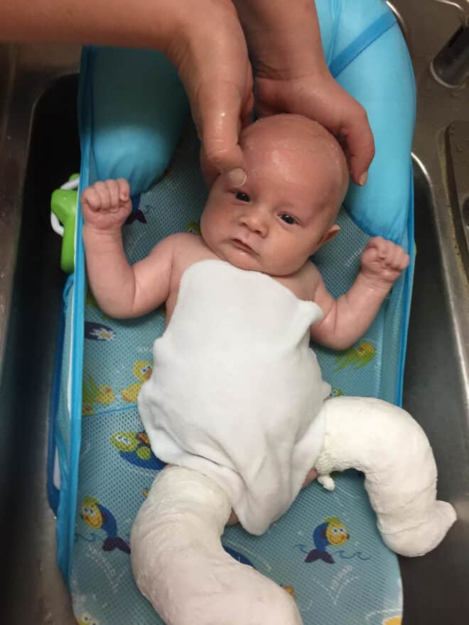 Why My 4 Year Old Is In Full Leg Casts + A Wheelchair Tastes Lovely